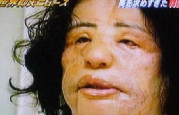 Foto - Yüzüne yemeklik yağ enjekte etti