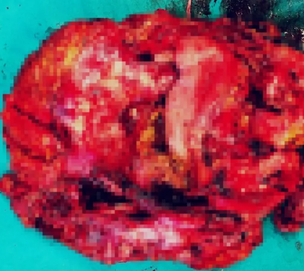 Foto - Zayıfladığını sanıyordu ama... Karnından çıkana kimse inanamadı!