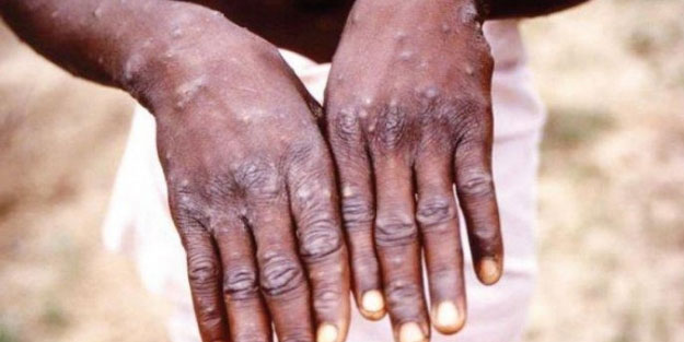 Maymun çiçeği virüsü