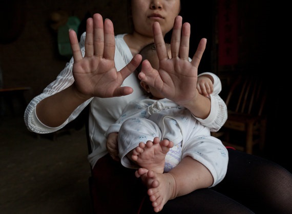 Hong bebeğin annesi de poldaktilizm hastası, toplamda 12 el ve 12 ayak parmağı var.