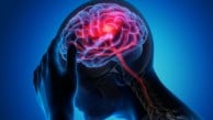 Beyin sisi bakın hangi hastalığın habercisi?