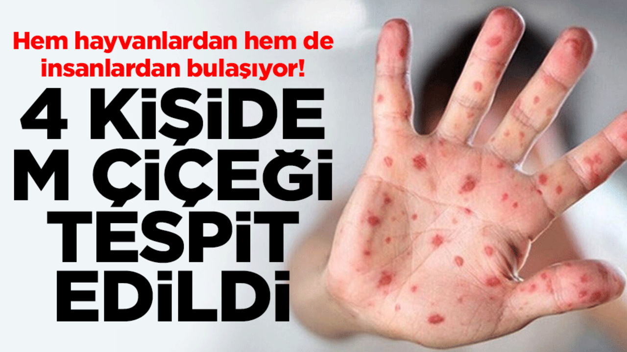Hem hayvanlardan hem de insanlardan bulaşıyor! 4 kişide M çiçeği vakası tespit edildi