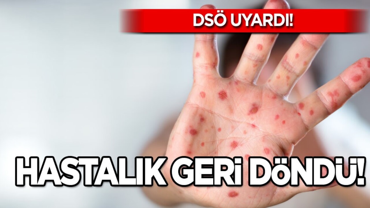 Kızamık geri döndü! Çok sayıda can kaybı var! Avrupa ayağa kalktı! DSÖ uyardı: Ölüm tehdidi çağrısı yaptı