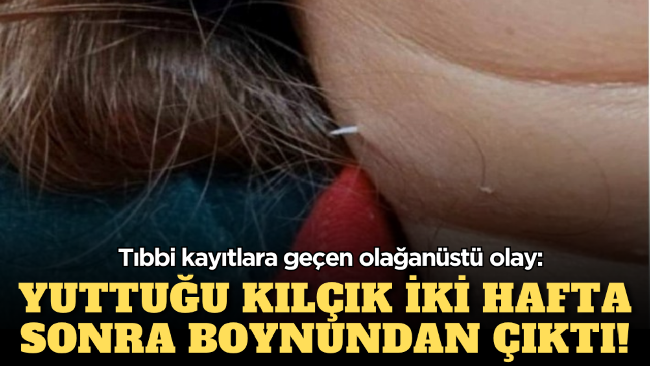 Tıbbi kayıtlara geçen olağanüstü olay: Yuttuğu kılçık iki hafta sonra boynundan çıktı!