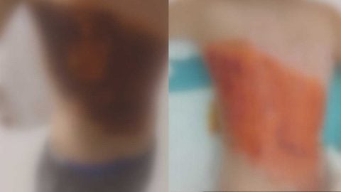 Arnavutköy’de 12 yaşındaki çocuğun ateşe verildiği iddiası: Tedavisi sürüyor