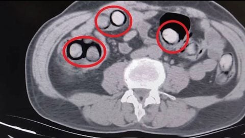 Röntgende ortaya çıktı! Mide ve bağırsaklarında 101 parça uyuşturucu bulundu