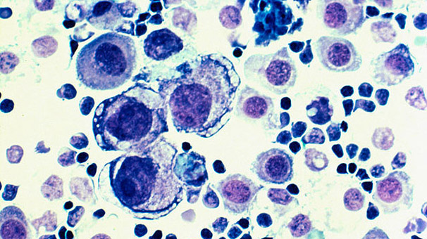 10 kanser türünün erken tanısında 'çığır açacak' formül