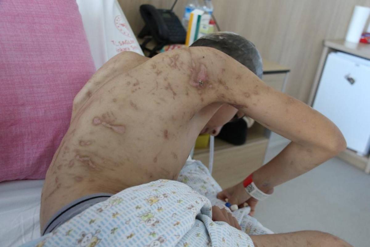 10 köpeğin saldırısına uğrayan 12 yaşındaki Enes, 9 cerrahi operasyon geçirdi
