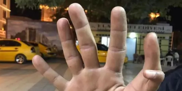 11 parmaklı adam görenleri hayrete düşürüyor!