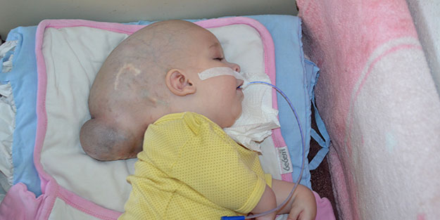 12 aylık bebeğin dramı yürekleri burkuyor! Beyninin bir kısmı kafatasının dışında büyüyor