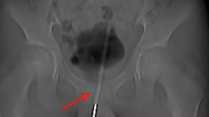 12 yaşındaki çocuğun cinsel organından çıktı! Annesi gerçeği itiraf etti