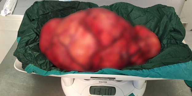 13 buçuk kiloluk dev tümör, başarılı bir ameliyatla alındı