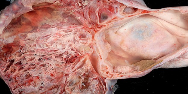 15 dakikada tümörlerden kurtulmak mümkün