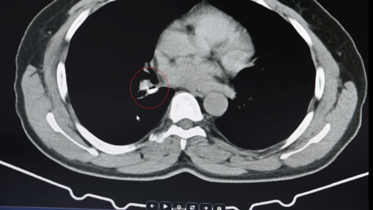 1,5 yıl astım tedavisi gördü! Gerçeği öğrenince şok geçirdi!