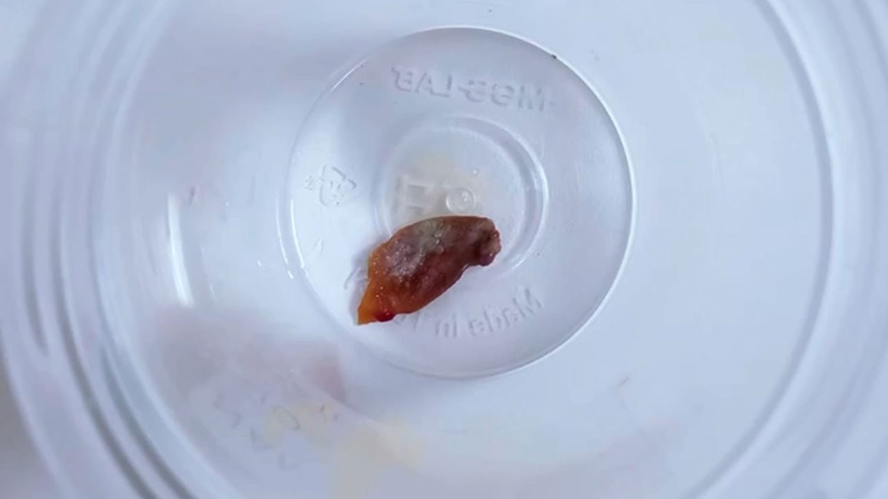 1,5 yıl süren öksürüğün sebebi şaşırttı! Bakın akciğerinden ne çıktı