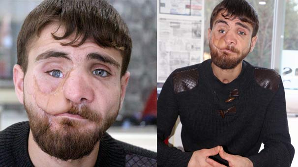 16 yaşında yüzü bu hale geldi! İnsanların bakışı...