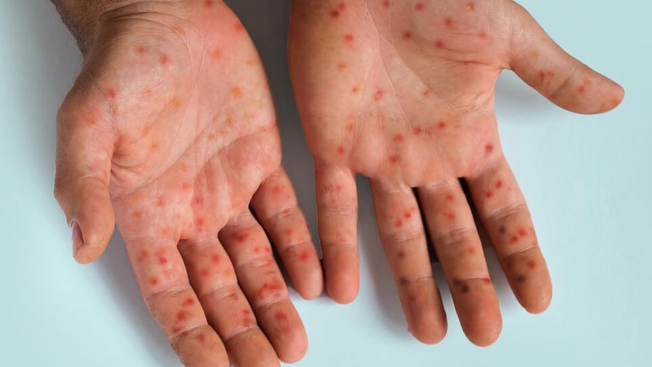 17 kişi hayatını kaybetti! O ülkede kızamık salgını alarmı