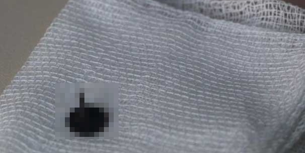 17 yaşındaki genç kızın akciğerinden bakın ne çıktı