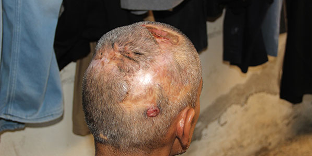 20 yıldır kafasında çivilerle yaşıyor! Çaresiz adam yardım bekliyor