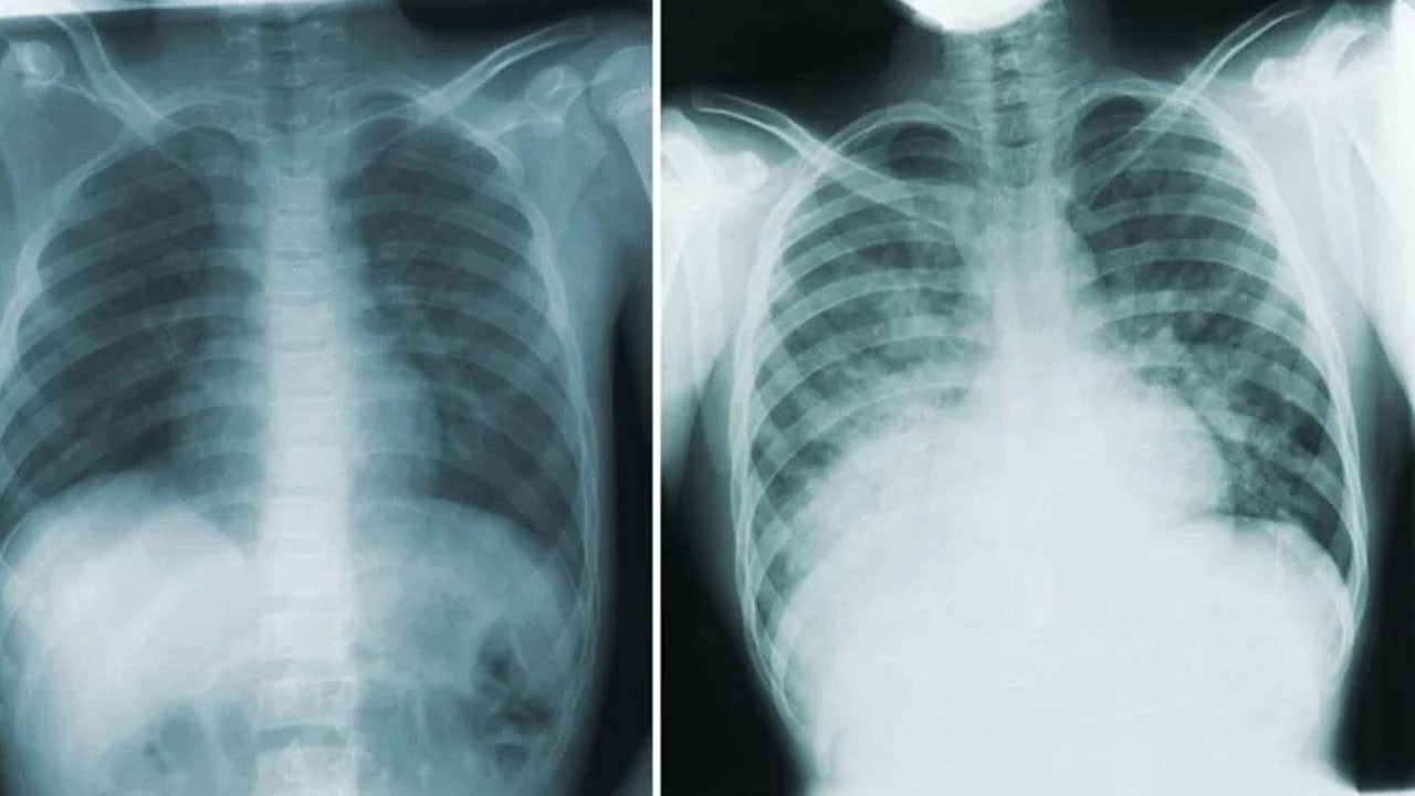 2007’den bu yana bir ilk! Akciğer vebası can aldı