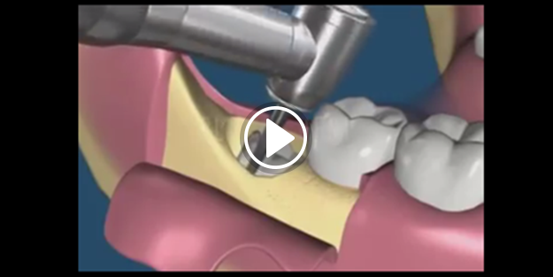 20'lik diş nasıl çekilir?