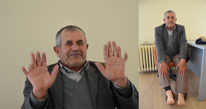 24 parmağını gören şaşırıyor