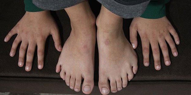 24 parmaklı çocuğa, devlet özel ayakkabı yaptırdı
