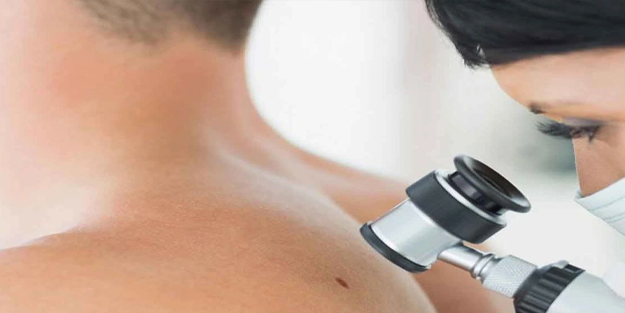 28 ilde cilt kanserine karşı ücretsiz 'ben' taraması