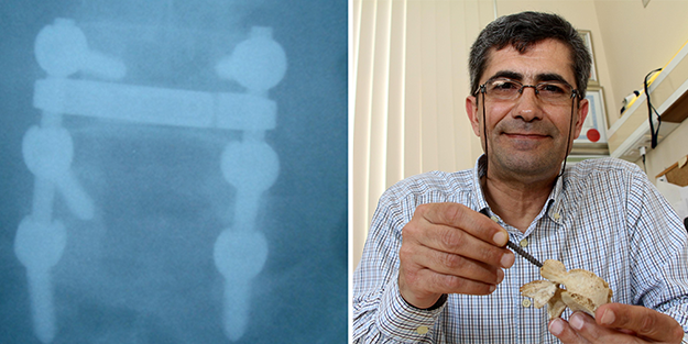 3 boyutlu yazıcıda omurga vidası üretildi