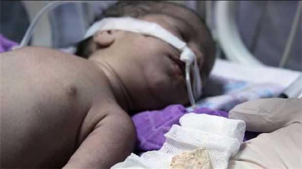 3 günlük bebeğin boğazından taş çıktı