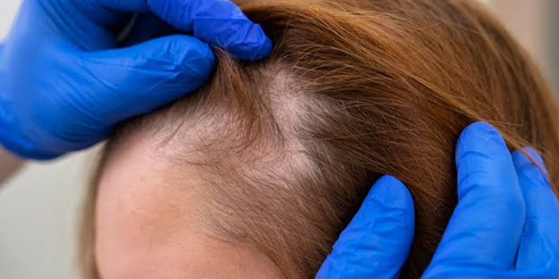 3 Malzeme ile dökülen saçlarınızı geri kazanacaksınız: bunu da deneyin! Her yerden saç fışkıracak!