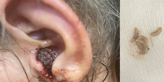 3 yaşındaki çocuğun kulağından 23 tane canlı kurtçuk çıkarıldı!