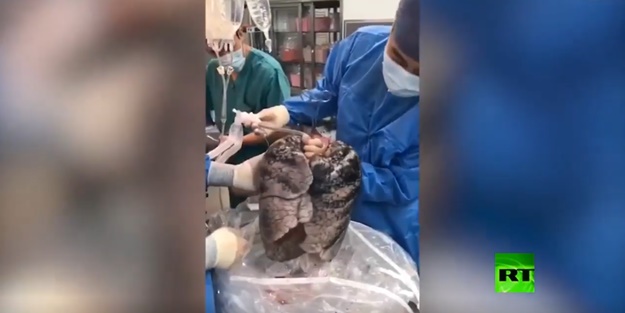 30 yıldır sigara içiyordu! Doktorlar akciğerini çıkardı