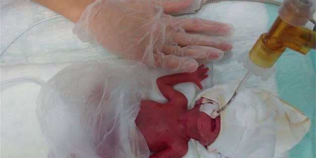 380 gram doğmuştu, hayata tutundu!