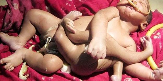 4 kol ve 4 bacaklı bir bebek doğdu