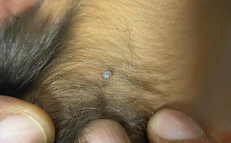 4 yaşındaki çocuğa kene yapıştı