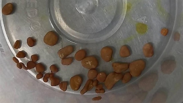 5 aylık bebeğin böbreğinde 56 taş