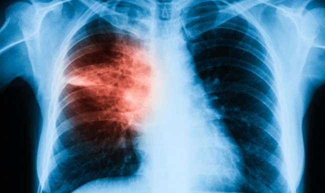 5 yıl öncesinden akciğer kanseri teşhisi