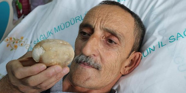 522 gram ağırlığında! Gören doktorlar şaşkına döndü