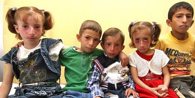 6 kuzen aynı hastalıktan muzdarip