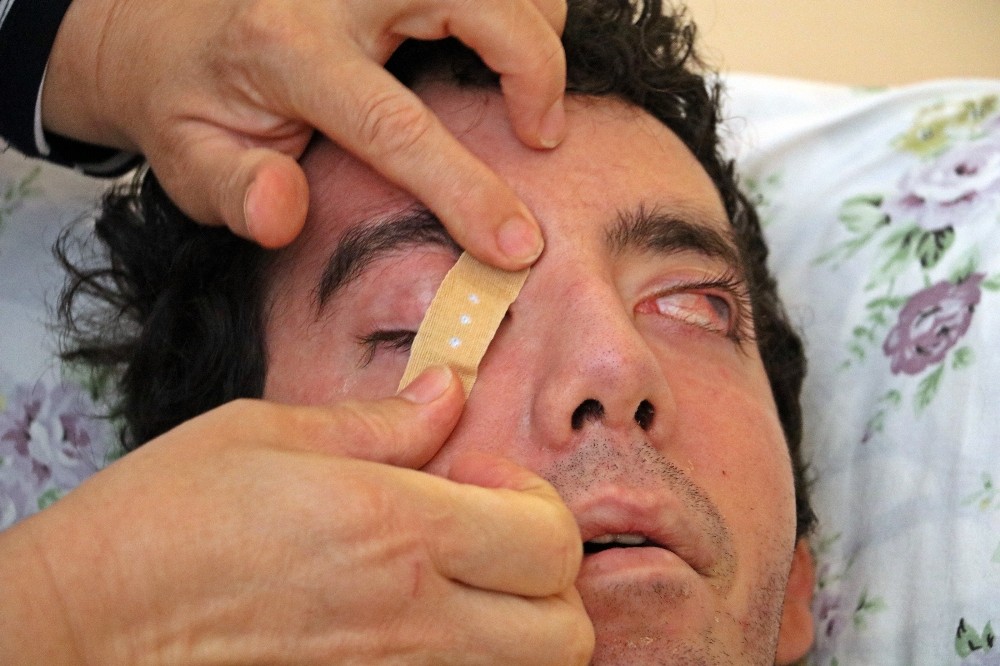 6 yıldır gözlerini kırpamıyor, kan çanağına dönen gözleri bantla kapatılıyor 