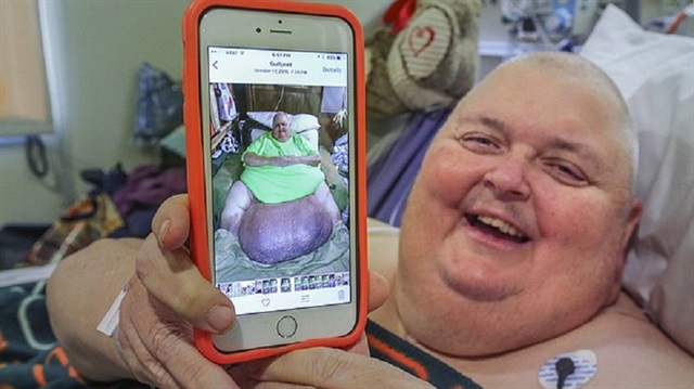 60 kiloluk tümörden kurtuldu