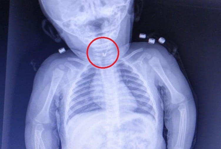 7 aylık bebeğin yemek borusundan çengelli iğne çıktı 