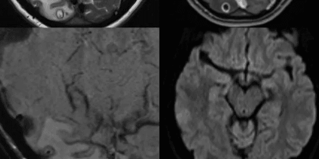 7 yıl migren ağrısı çekti! Beyninden çıkanlar şoke etti