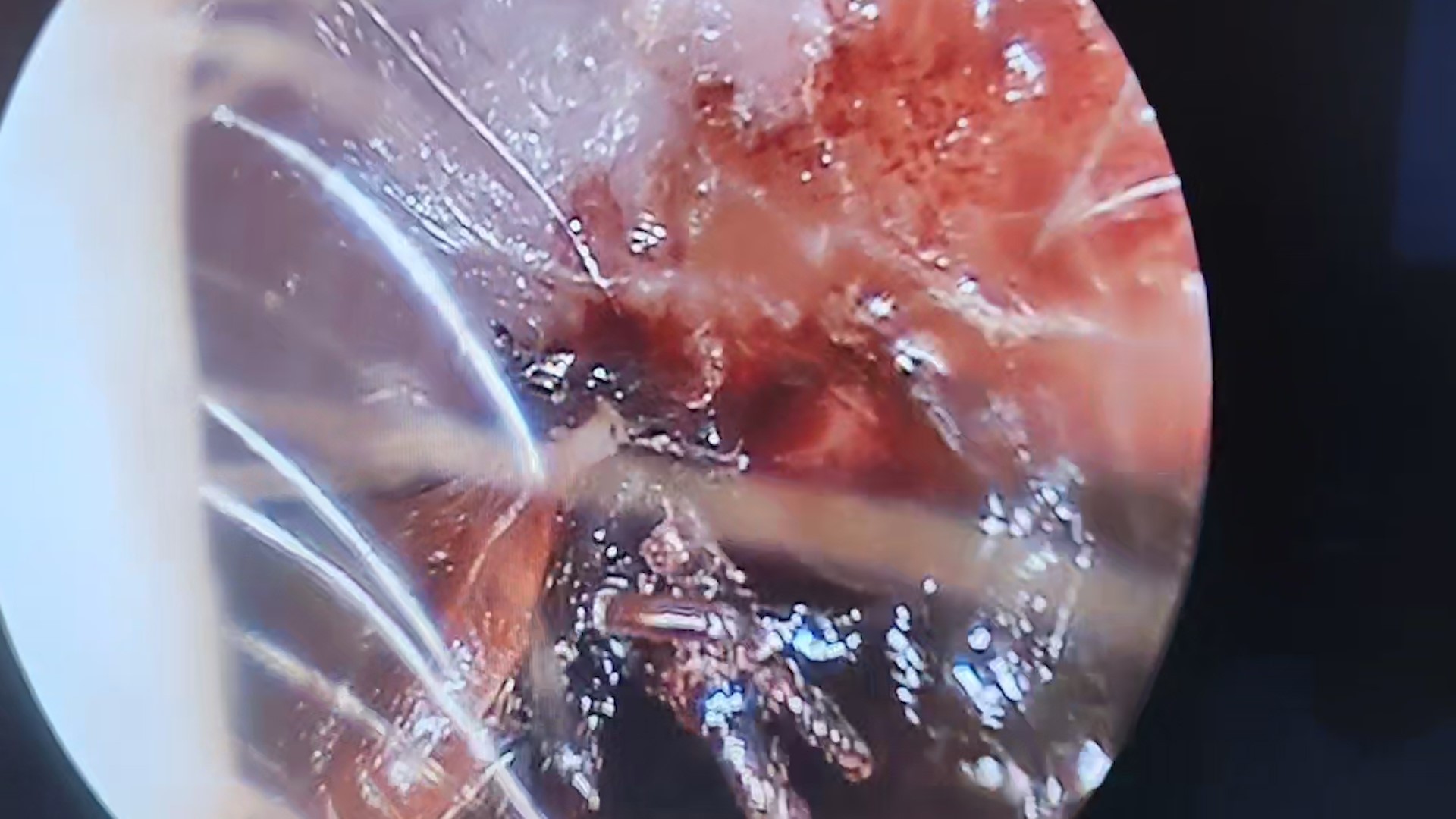 70 yaşındaki kadının kulağında hareket eden kene görüldü