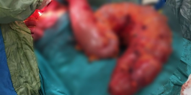 Karnından otomobil lastiği büyüklüğünde tıkanmış bağırsak çıkarıldı