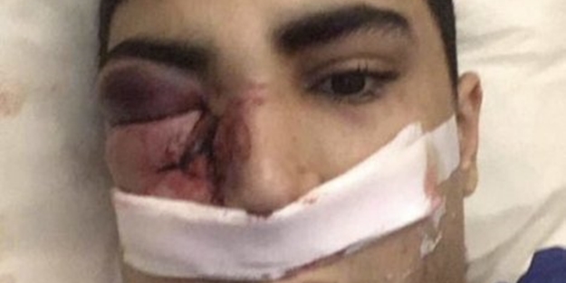 8 Fransız polisi saldırdı, bir gözünü kaybetti