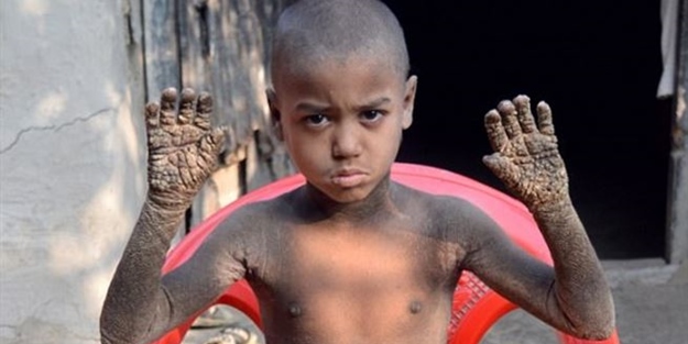 8 yaşındaki bu çocuğun vücudu ‘taşlaşıyor’