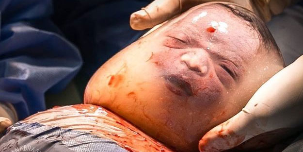 80 binde bir görülüyor! Yeni doğan bebeği görenler şok oldu