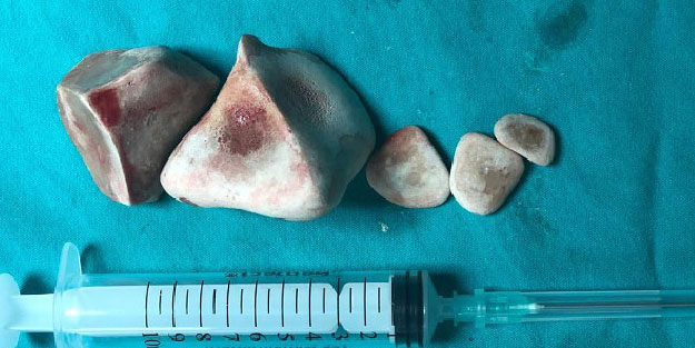 95 yaşındaki adamın idrar torbasından 424 gram taş çıktı